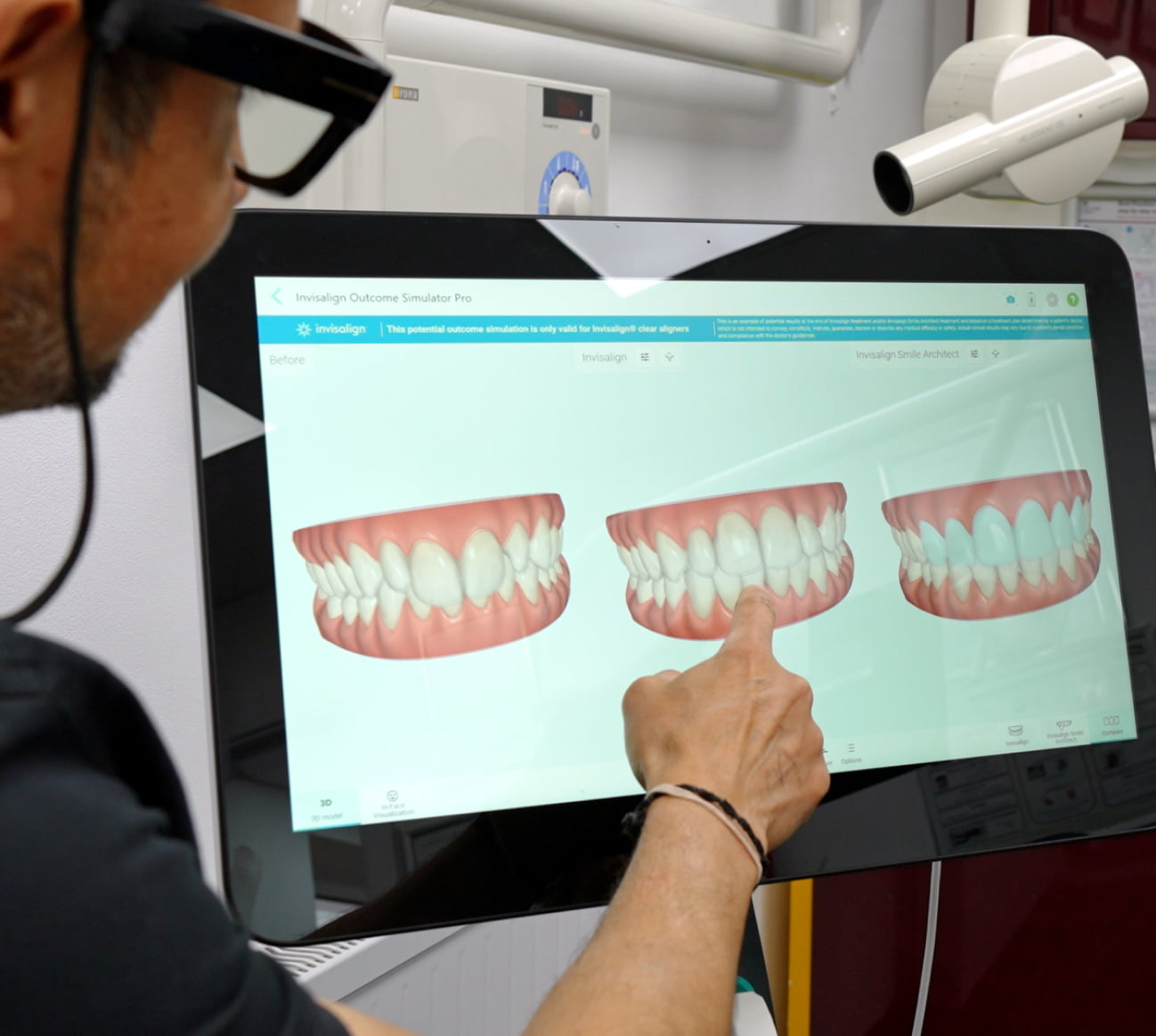 Invisalign Clear Aligners