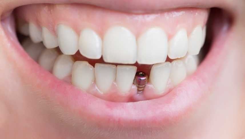 Single tooth implant