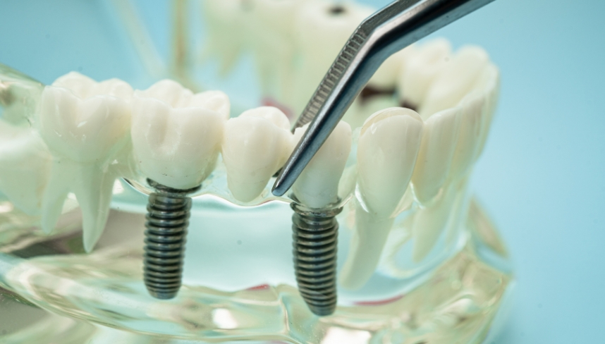 Dental implant Bridges
